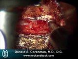 Anterior Cervical Decompression and Fusion (ACDF) | Live Spine Surgery Video | Spine Surgeon