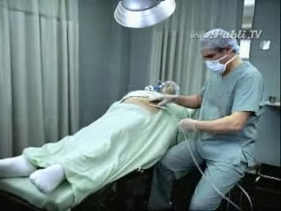 LiposuccionFG