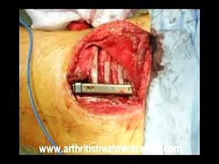 Spinal Fusion Surgery - Don't Do It!