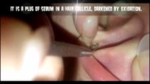 What is a Blackhead #1 USA Greatest World Comedones