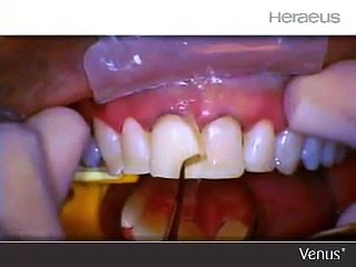 Mylar Pull Technique