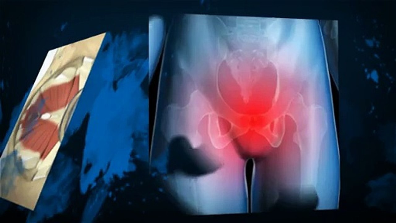 Pelvic Floor Prolapse