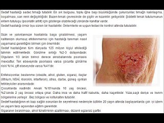 SEDEF HASTALIĞI (PSORİASİS)