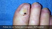 Nail bed biopsy procedure of pigmented lesion