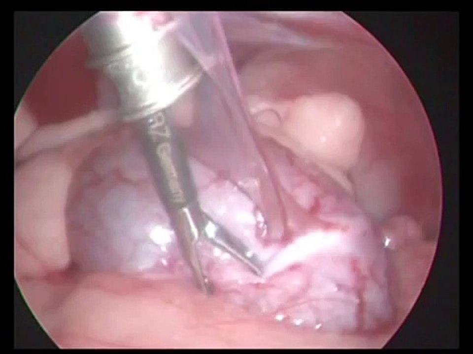 Laparoscopic assisted keyhole cystoscopy