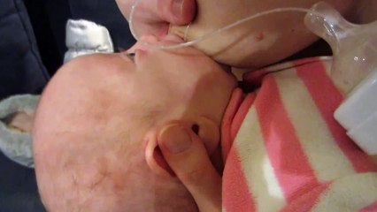 Baby with cleft palate