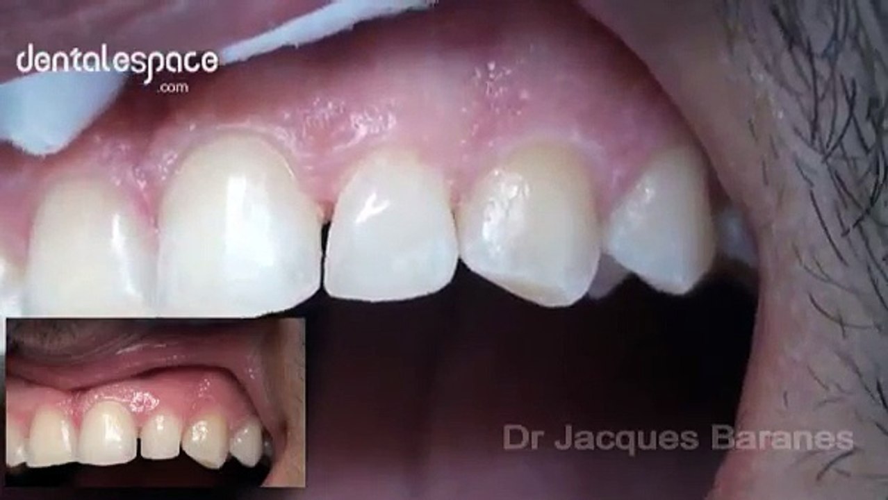 facettes dentaires céramique sans préparation