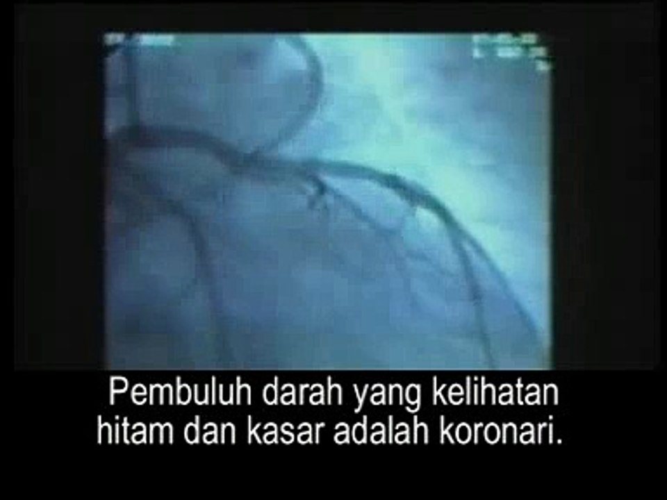 Jantung dan Strok