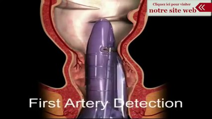 La méthode THD hémorroïdes (vidéo)