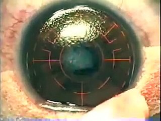 عمليه الليزك مجانا لموظفى موبايلى وساب وعوائلهم