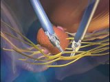 Robotic Prostectomy | da Vinci Robot Cancer Surgery | North Texas