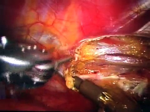 Podcast: Beating Heart Totally Endoscopic Coronary Artery...