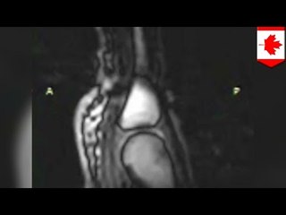 ¿Se han preguntado que pasa cada vez que crujen sus nudillos? Resonancia magnética responde