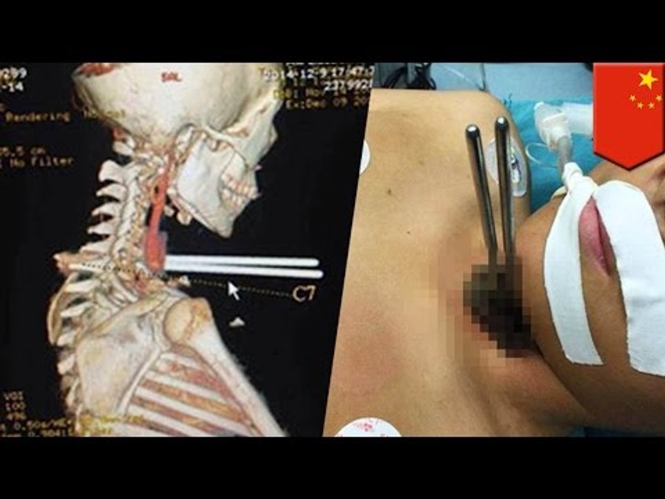 Freak accident results in boy jamming chopsticks into his neck