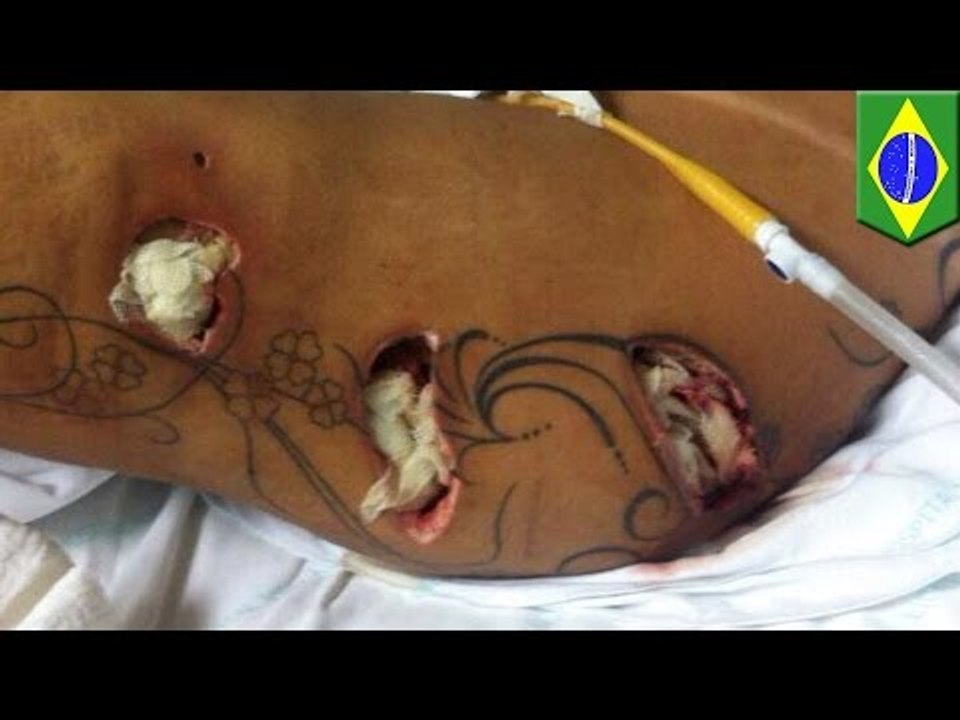 Plastic surgery gone wrong: Miss Brazil Bum-Bum model has emergency butt implant surgery