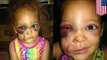 Bullied Mississippi girl AvaLynn Harris denied justice as school blames injuries on accident