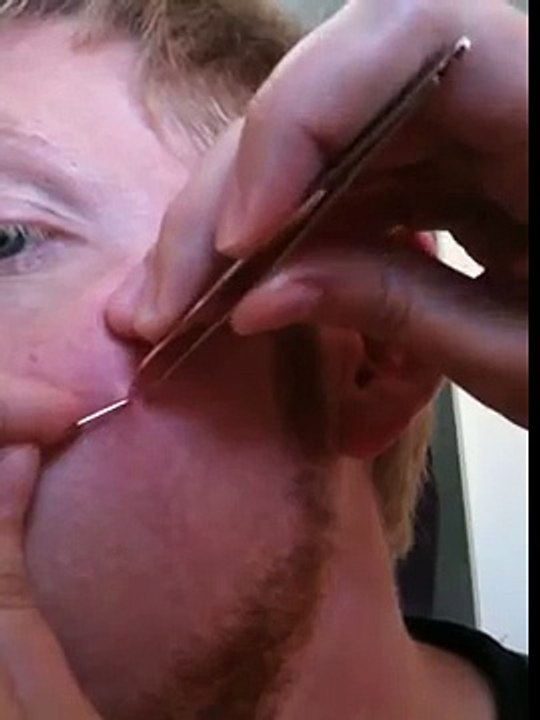 My girlfriend digs an ingrown hair out of my face
