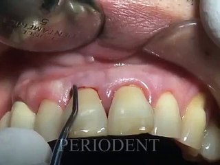Upper Anterior Teeth Root Planing