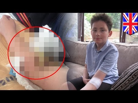 Boy's arm gets impaled by door handle, millimeters away from major artery