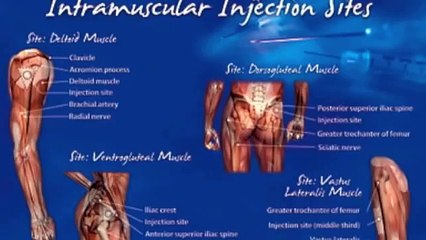 Intramuscular Testosterone Injection Techniques