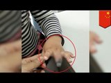 AMPUTATION: Après une blessure bénigne, une fillette se fait amputer un doigt