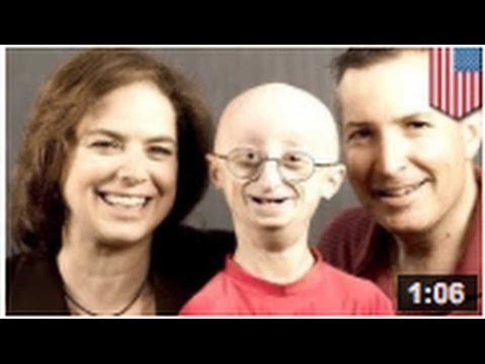 Le progeria: une maladie génétique extrêmement rare