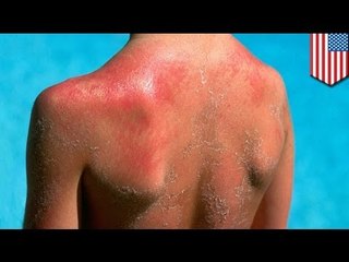 Texas school bans sunscreen, claims it's too 'toxic' for children to use