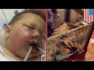 Toddler critically burned in SWAT raid, takes stun grenade to face