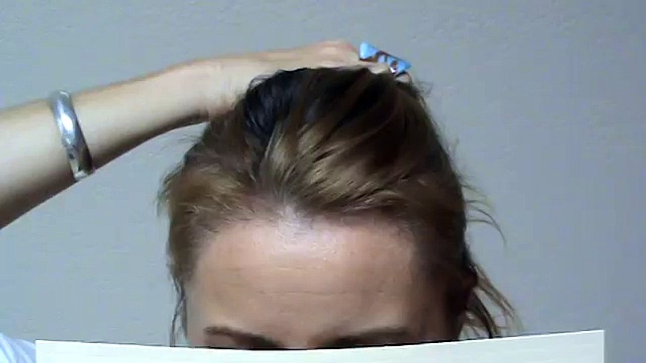 Woman Hair Transplant Restoration Surgery Before After Result Bald High Hairline www.mhtaclinic.com