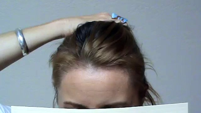 Woman Hair Transplant Restoration Surgery Before After Result Bald High Hairline mhtaclinic.com