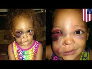 Pobita dziewczynka. Przedszkole umywa ręce.