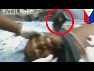 Operacja: telefon utknął w gardle mężczyzny.