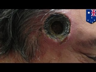 Shocking photos show how black salve left inch-wide hole in man's head