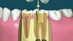 Root Canal Treatment- happy dental care.flv
