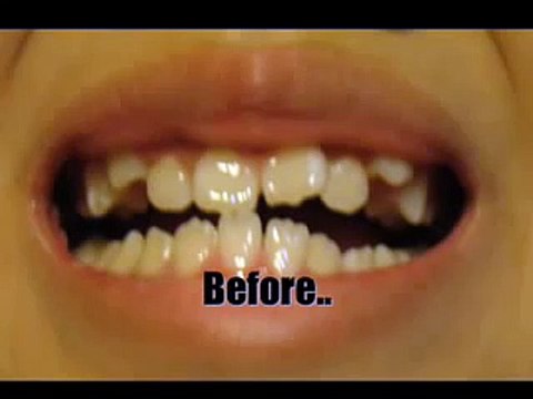 Braces: 2 MONTHS (watch my updated FULL braces time lapse)