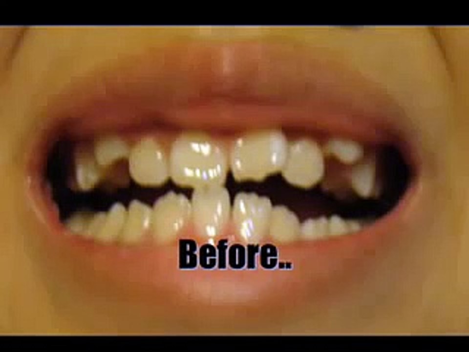 Braces:  2 MONTHS  (watch my updated FULL braces time lapse)