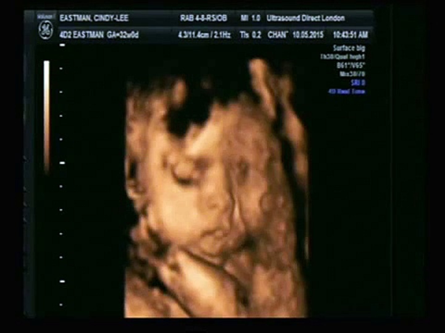4d Baby Scan Wimbledon London May 15 Video Dailymotion