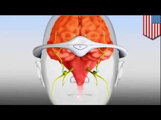 FDA approves first-ever device to prevent migraines