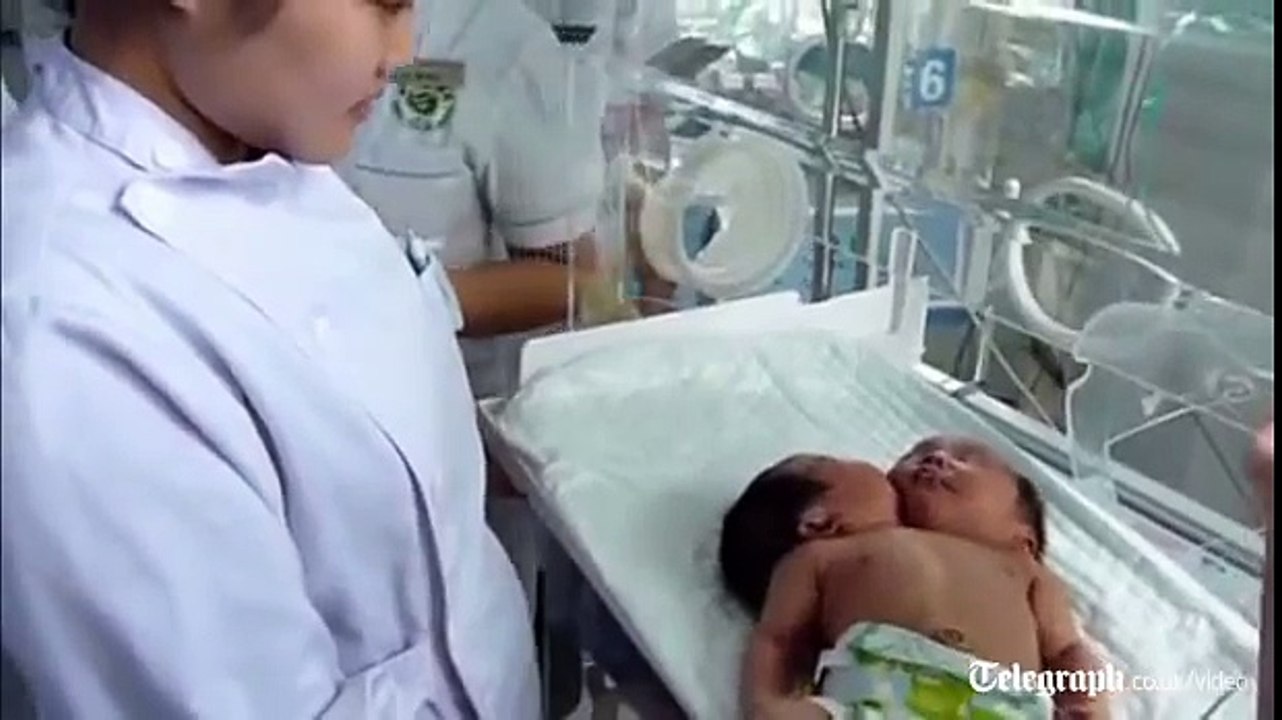 Two-headed baby: Amazing conjoined twins born in China