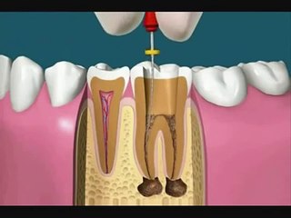 como es una endodoncia - Matar el nervio dental (animacion)