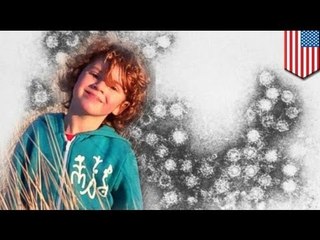 Polio-like disease paralyze dozens of children in California