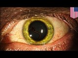 Ebola virus turns doctor's eyes green, virus lurks in eyeballs and testicles [a]- TomoNews