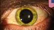 Ebola virus turns doctor's eyes green, virus lurks in eyeballs and testicles [a]- TomoNews