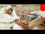 Miracle surgery: Severed hand saved after being attached to man's ankle