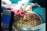 Operation intestinal worms Ascariasis bolus‬‏