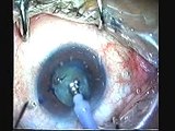 phaco PCT and vitrectomy with sulcus PMMA IOL implant