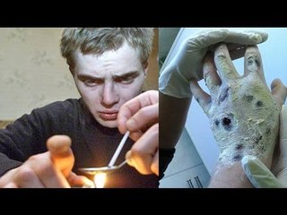 Flesh-eating heroin alternative makes appearance in U.S.