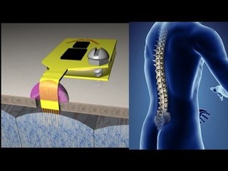 New device in UK to restore bladder control to the paralyzed