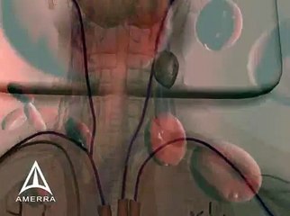 Nanospectra - Cancer Therapy 3D Medical Animation