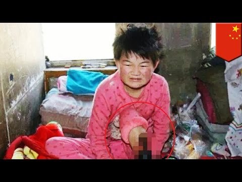 Child leg amputation: 11 year old girl needs surgery to survive, family too poor - TomoNews